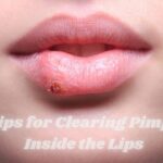 5 Tips for Clearing Pimples Inside the Lips