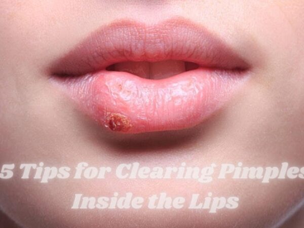 5 Tips for Clearing Pimples Inside the Lips