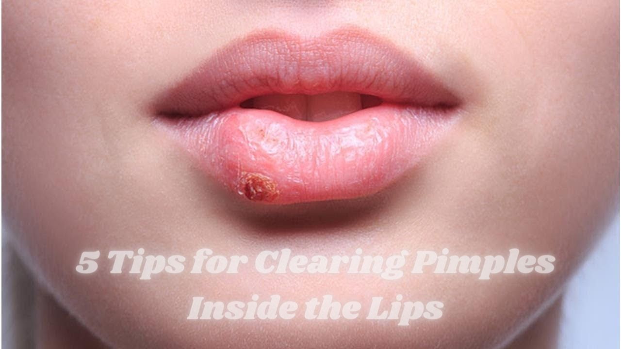 5 Tips for Clearing Pimples Inside the Lips